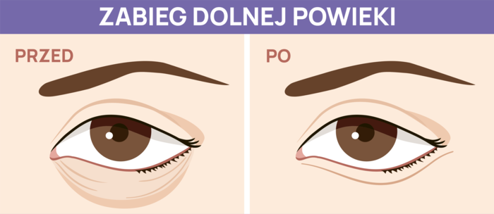 plastyka powiek dolnych
