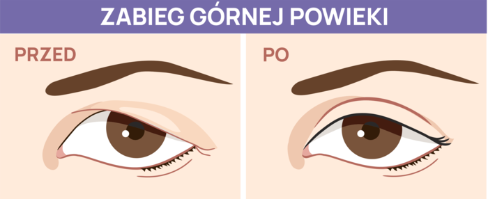 plastyka powiek górnych